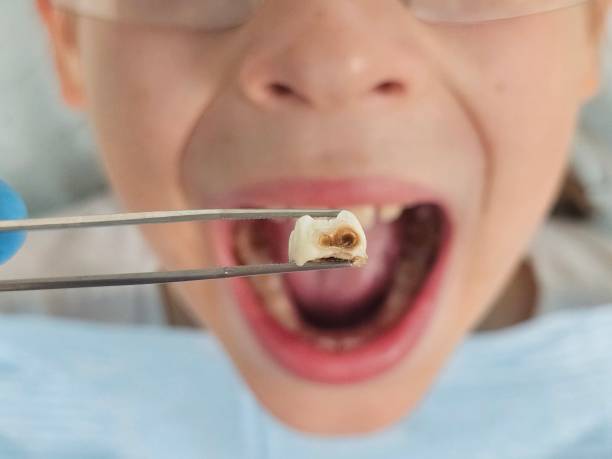 Best Emergency Root Canal Treatment in Potterville, MI